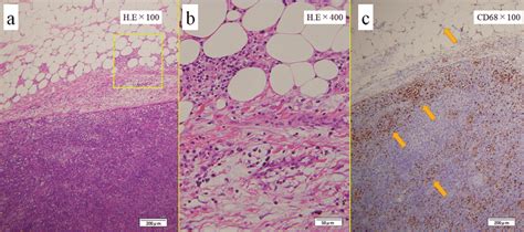 Pathological Findings Of Mesenteric Adipose Tissue With Intraabdominal