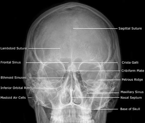 Frontal Sinus - New