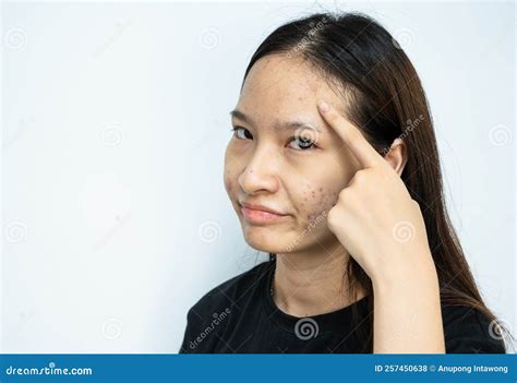 Asian Woman Pointing To Acne Problems Inflamed On Her Forehead Stock