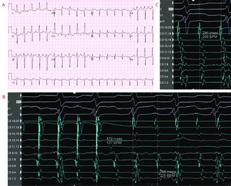 Twelve Lead Electrocardiogram A Entrainment From The Right Atrial