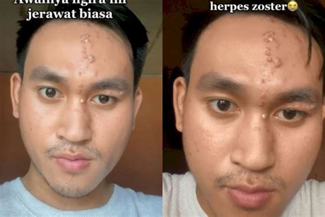 Berita Herpes Zoster Di Wajah Terbaru Hari Ini Grid Health