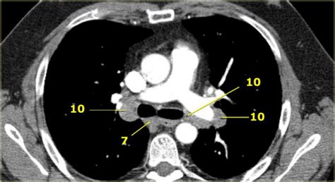 The Radiology Assistant Mediastinal Lymph Node Map