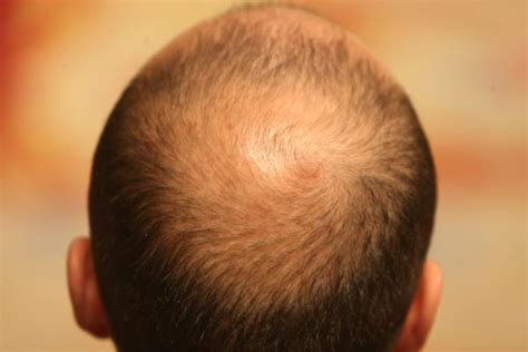 Todo Lo Que Necesitas Saber Sobre La Alopecia Tipos Y Causas