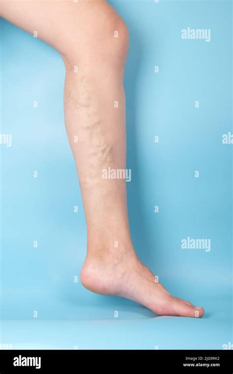 Woman Leg With Blockage Of Varicose Veins On A Blue Background Stock