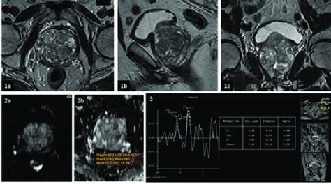 Benign Prostatic Hyperplasia Bph 1a Axial 1b Sagittal And 1c Download Scientific