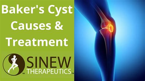 Baker S Cyst Causes And Treatment YouTube