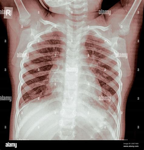 Chest X Ray Of A 3 Year Old Female Infant Front View Stock Photo Alamy