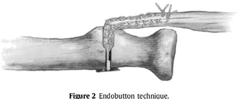 Figure From Higher Failure Rate Of Suture Anchors In Partial Distal