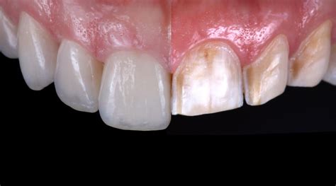 Amelogenesis Imperfecta - Full-Mouth Rehabilitation with Porcelain ...