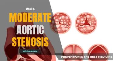 An Easy Guide To Charting Aortic Stenosis Sound MedShun