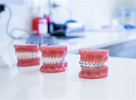 Braces Colours Choosing The Right One Smile Team Orthodontics Blog