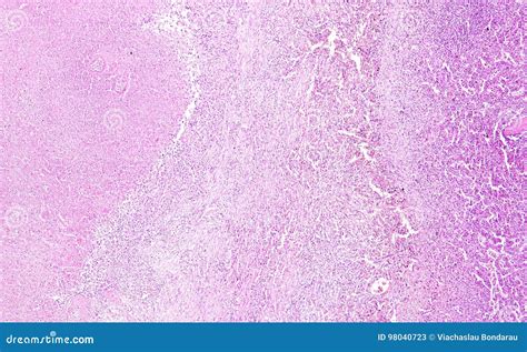 Histology Of Human Tissue Show Spleen Infarction At A Scarring Stage As Seen Under The