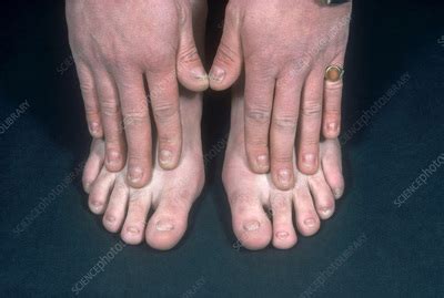 20 Nail Dystrophy Syndrome Stock Image C055 9834 Science Photo