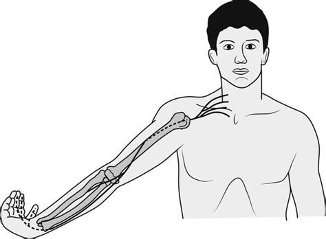 Lateral Elbow Pain With Cervical And Nerve Related Components