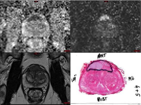 Figure From Bi Parametric Mri Trus Fusion Targeted Repeat Biopsy