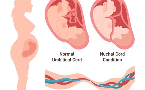 Was Your Babys Hie Brain Injury From A Nuchal Cord Preventable