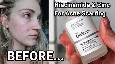 Before And After Using The Ordinary Niacinamide Online UK | dpise2022.dps.uminho.pt