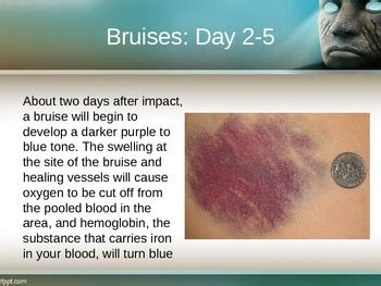 Bruise Colors and Age by Shelle House | Teachers Pay Teachers