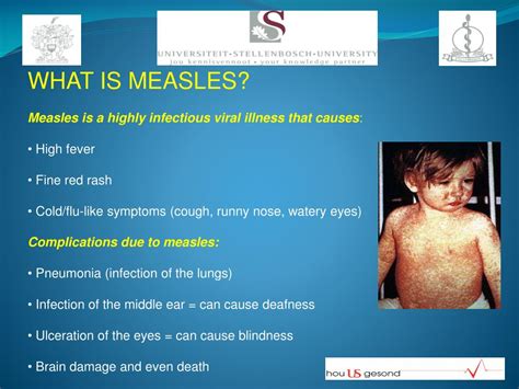 Ppt Measles Powerpoint Presentation Free Download Id 1465716