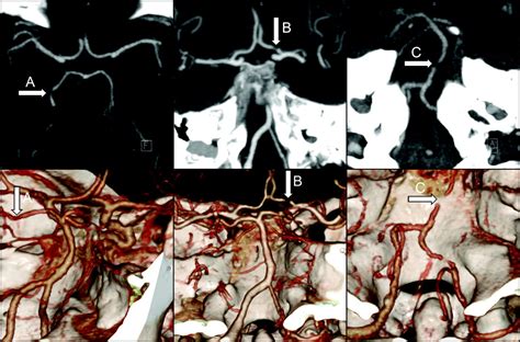 Prevalence And Calcification Of Intracranial Arterial Stenotic Lesions