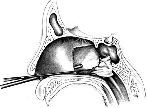 Endoscopic Resection Of Juvenile Nasopharyngeal Angiofibroma