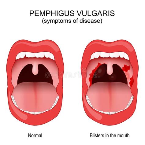 Pemphigus Vulgaris. Early Symptoms Inside the Mouth Stock Vector - Illustration of diabetes ...