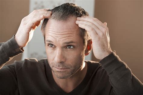 Alopecia Masculina Tratamientos Efectivos Que Debes Conocer