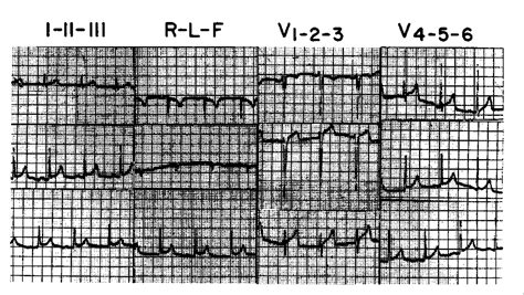 Differential Characteristics Of The Electrocardiogram In Early Repolarization And Acute