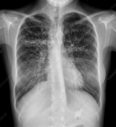 Cystic fibrosis, lung X-ray - Stock Image - C037/2769 - Science Photo ...