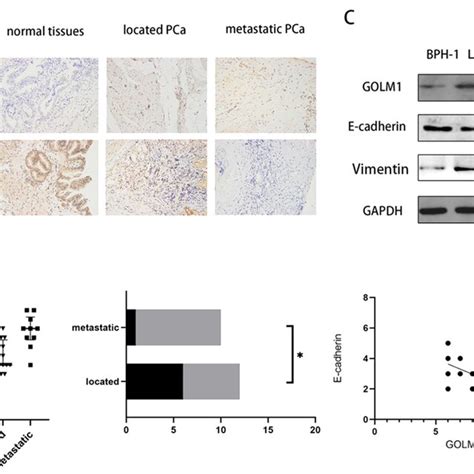 Expression Levels Of Golm And E Cadherin In Pc Tissues And Cells A