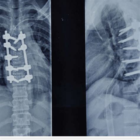 Postoperative X Ray After Fixation Ap And Lateral View Ap