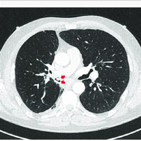 Coronal Slice Ct Thorax Showing Endobronchial Soft Tissue Lesion In