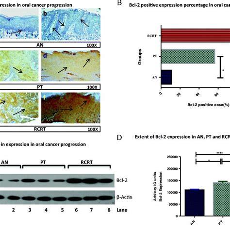 Bcl 2 Protein Expression In Adjacent Normal AN Primary Oral Tumor