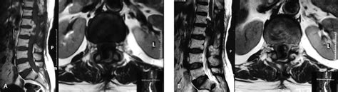 A Magnetic Resonance Imaging T1 Weighted Image Sagittal And Axial