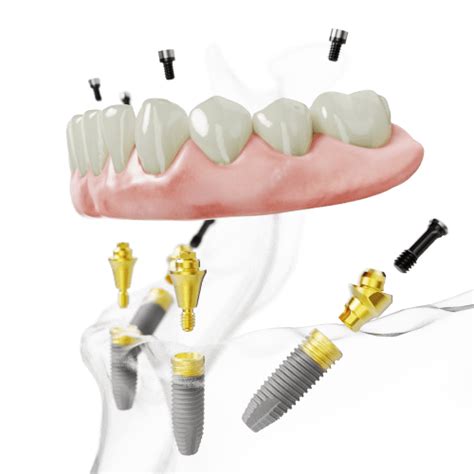 Fms Dental All On 4 Dental Implants Cost Price Hyderabad Kochi India