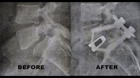 2 week post op L5-S1 Spinal Fusion - YouTube