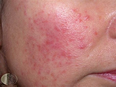 Rosacea Nose Bumps