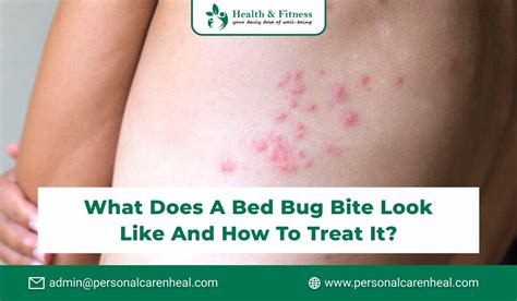 What Does A Bed Bug Bite Look Like And How To Treat It