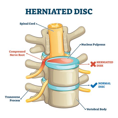 What Is A Herniated Disc Are There Noninvasive Treatments