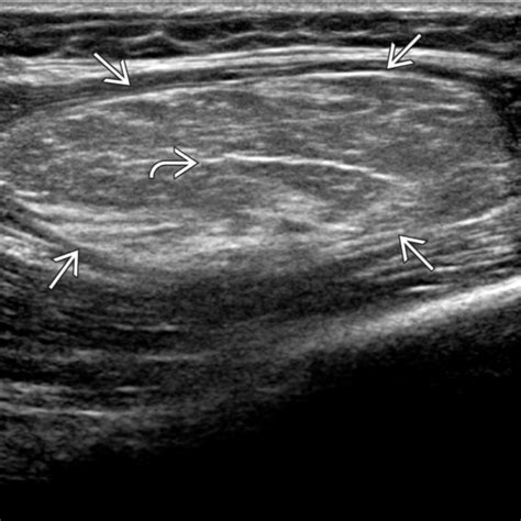 Lipoma Radiology Key