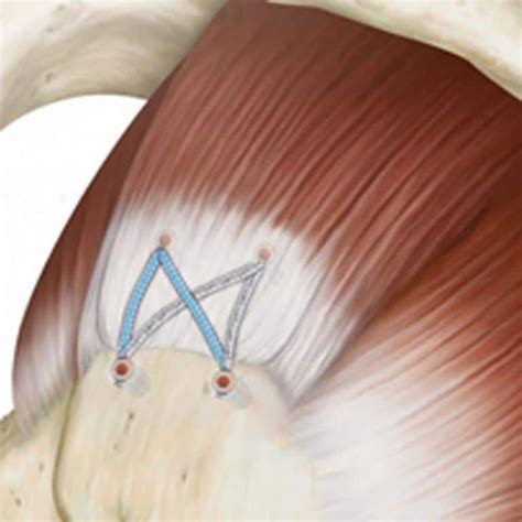 Rupture Coiffe des rotateurs Symptôme diagnostic opération