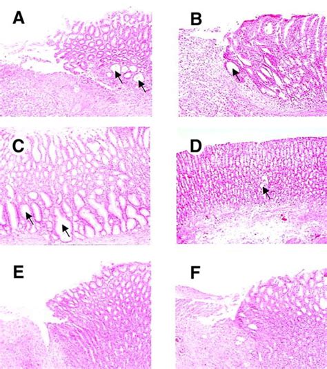 Gene Therapy For Gastric Ulcers With Single Local Injection Of Naked