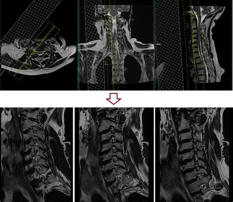 Mri Cervical Spine Exit Forearm View