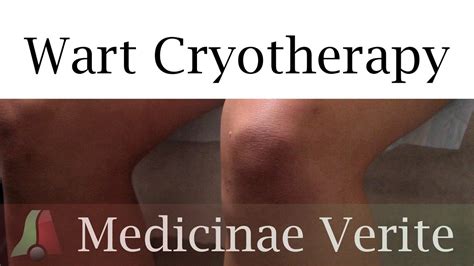 Wart Cryotherapy Auburn Medical Group Youtube