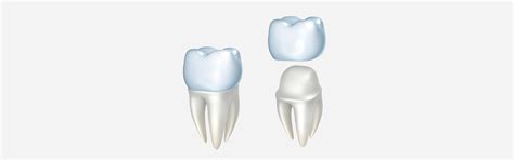 Things You Dont Know About Dental Crowns Blog