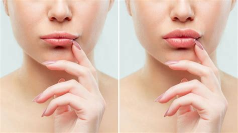 Fases Do Preenchimento Labial Conhe A Os Efeitos