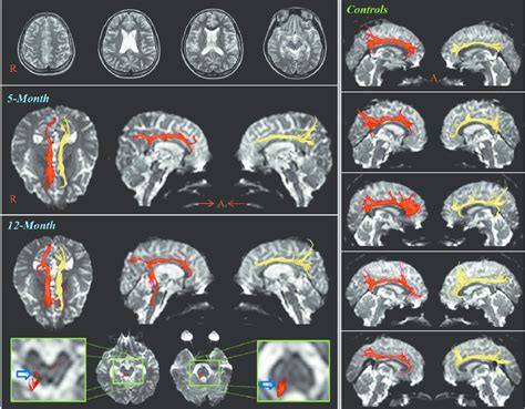 Conventional Magnetic Resonance MR Images And Diffusion Tensor