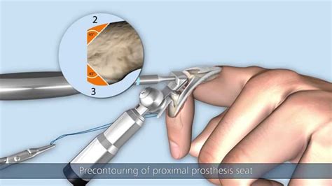 Capflex Pip Endoprosthetic Treatment Of Proximal Interphalangeal