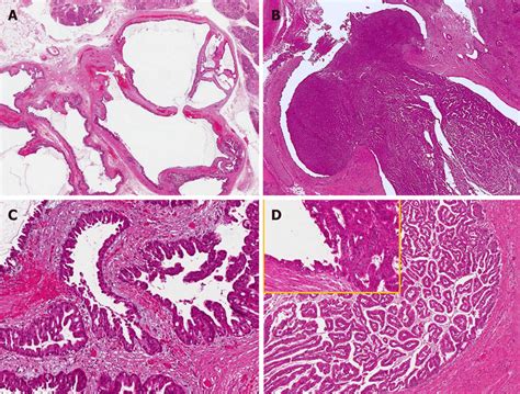 Common And Distinctive Features Of Pancreatic And Biliary Intraductal Download Scientific