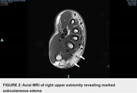 Figure 1 From Subcutaneous Sweet Syndrome Presenting As Cellulitis In A